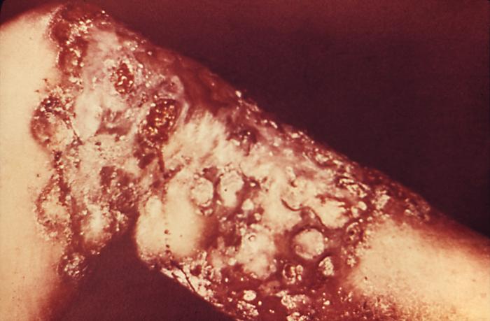 This patient presented with a papulo-squamous rash on the sole of the foot due to secondary syphilis. The second stage starts when one or more areas of the skin break into a rash that appears as rough, red or reddish brown spots both on the palms of the hands and on the bottoms of the feet. Even without treatment, rashes clear up on their own. Adapted from CDC