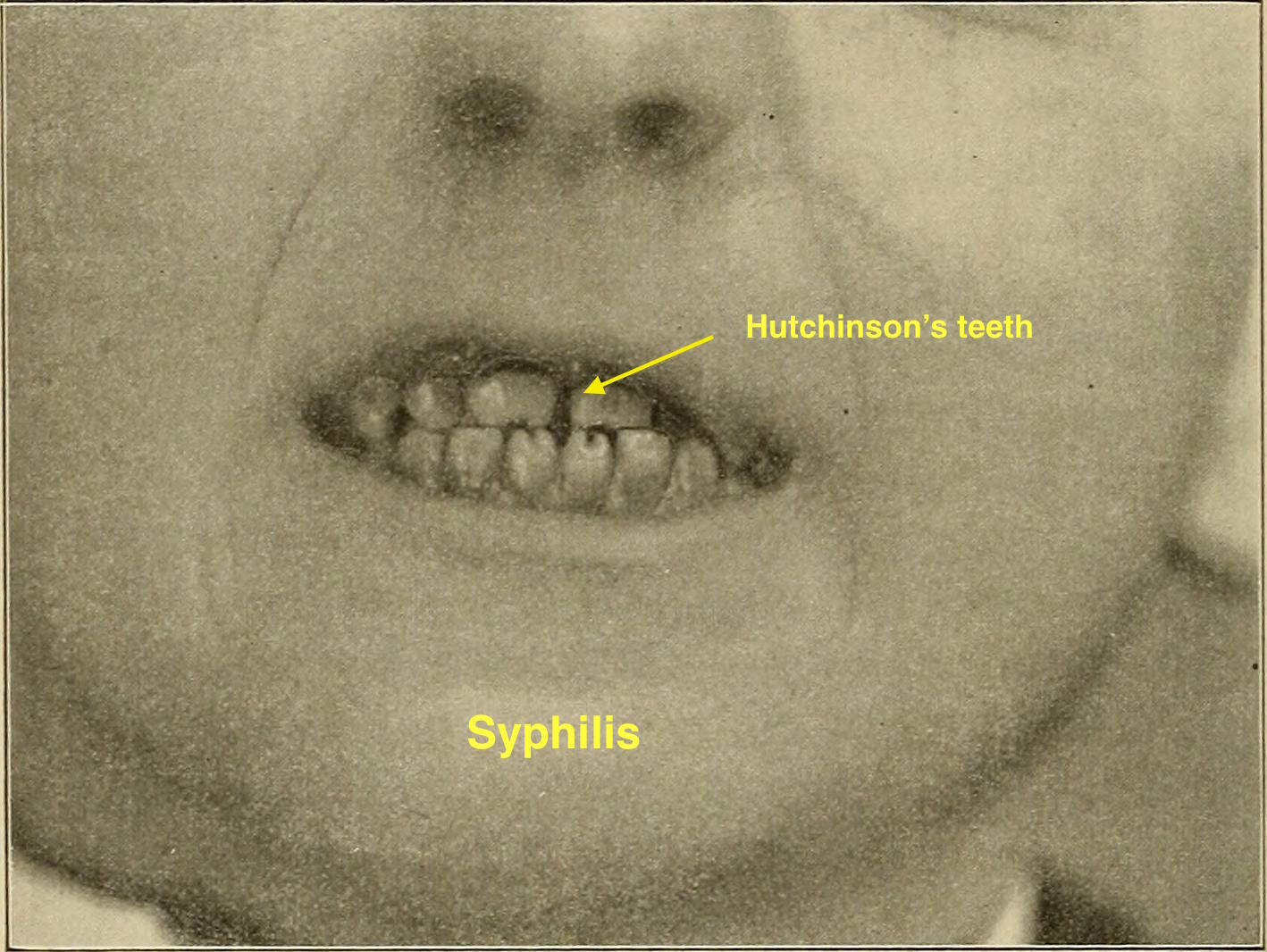 oral syphilis