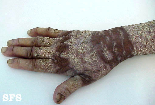 Darier's disease. Adapted from Dermatology Atlas.<ref name="Dermatology