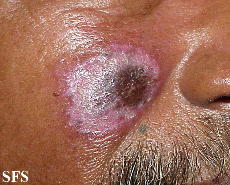 Discoid lupus erythematosus. Adapted from Dermatology Atlas.[17]