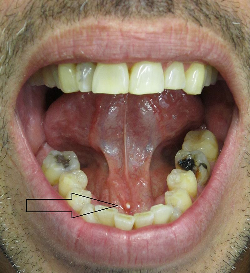 File:Salivary stone in submandibular salivary duct.jpg