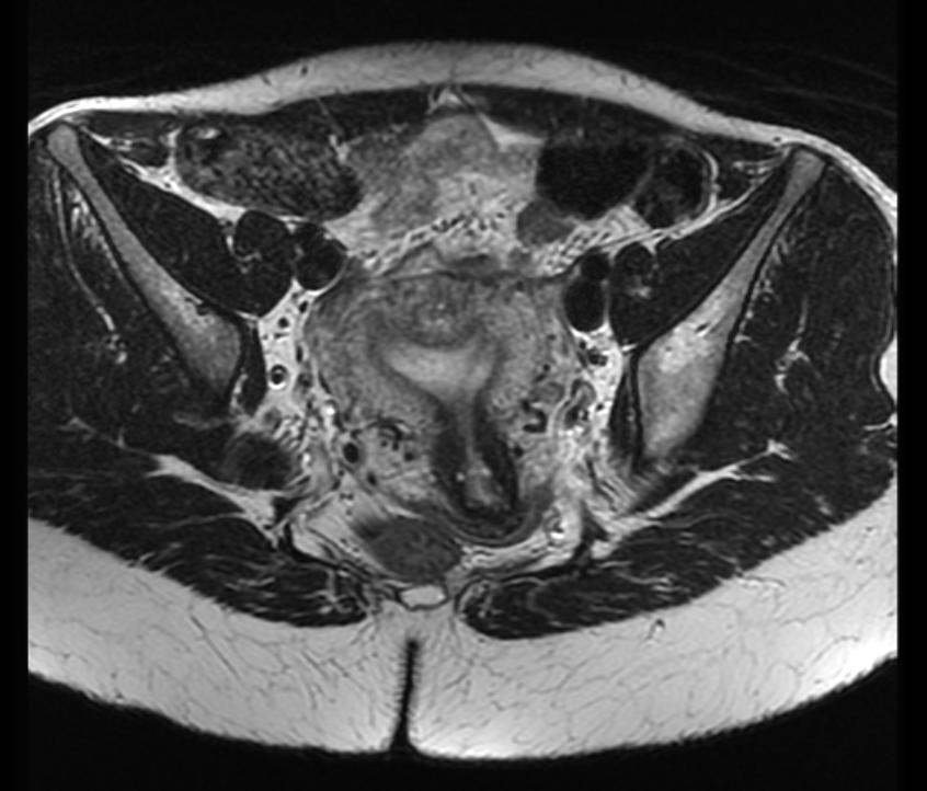 MR image demonstrates an arcuate uterus