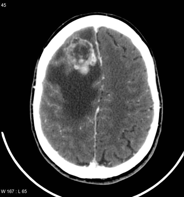 File:CT scan of brain metastasis 4.jpg