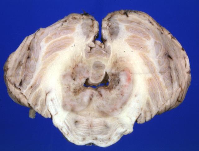 Brain: Microglioma: Gross; fixed tissue; cerebellum and fourth ventricle with periventricular tumor invasion