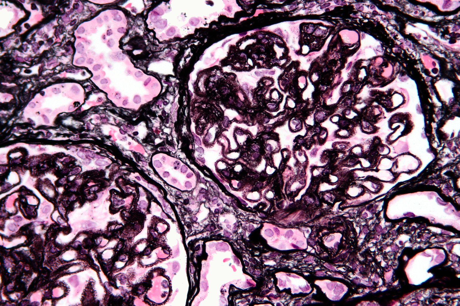 File:Membranous nephropathy - mpas - very high mag.jpg