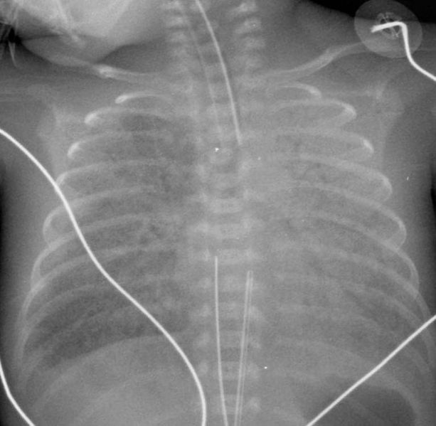 Chest X-ray Patient#1 Image courtesy of RadsWiki and copylefted