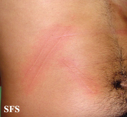 Dermatographic urticaria. Adapted from Dermatology Atlas.[3]