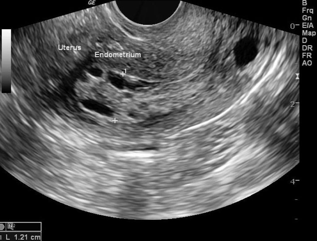 Endometrial hyperplasia[4]