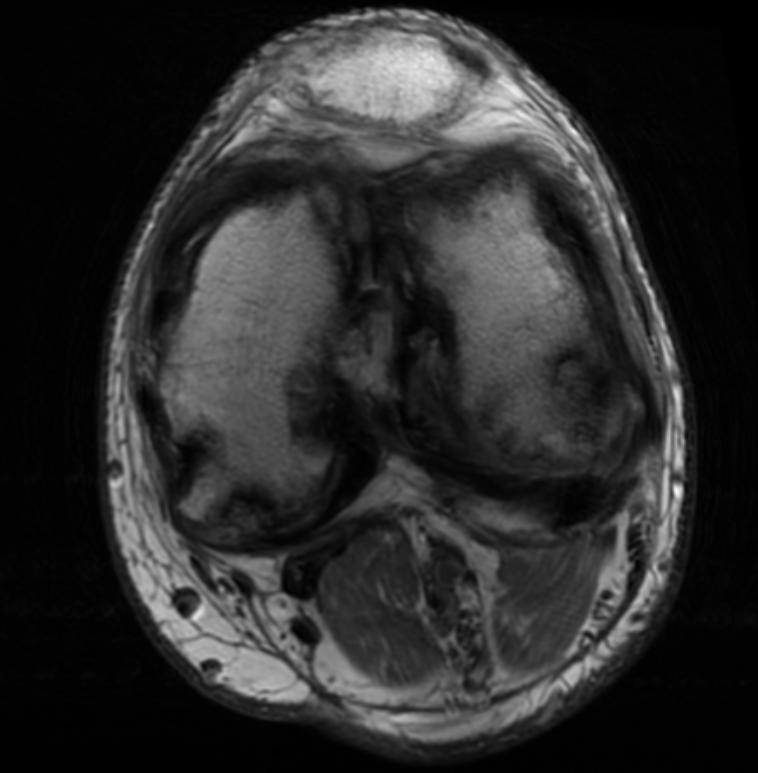 File:Hemophilia knee MRI 103.jpg
