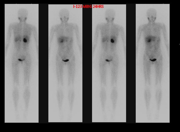 Case courtesy of Dr Hani Al Salam, <ref>"http://radiopaedia.org/">Radiopaedia.org</a>. From the case <a href="http://radiopaedia.org/cases/7932">rID: 7932<ref>