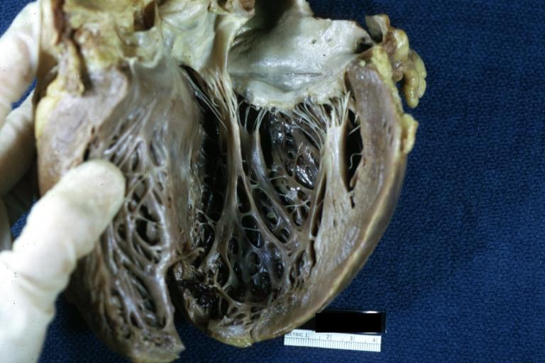 Papillary Muscle Thinning: Gross, natural color, band-like anterior papillary muscles secondary to healed infarct which is present in picture (but not easily seen). An excellent example for papillary muscle change