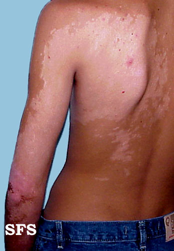 Image description. Adapted from Dermatology Atlas[5]