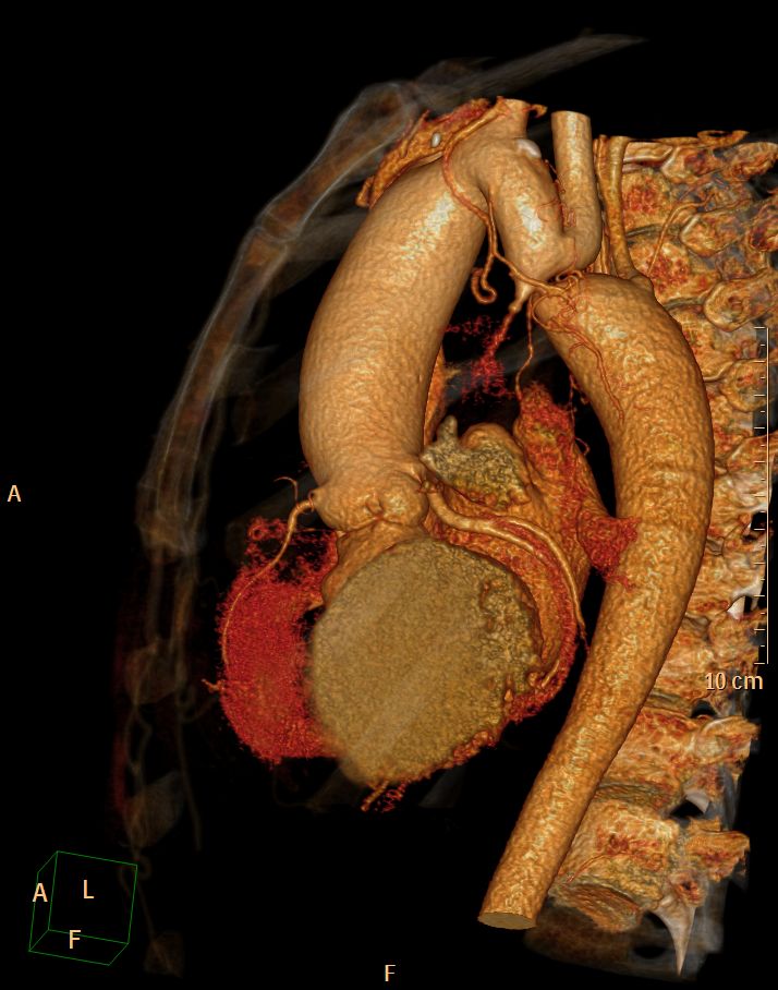 File:Coarctation-of-the-aorta-CT-001.jpg