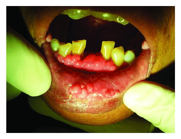 File:Multiple papules may also be noticed on the lower labial mucosa in Cowden syndrome.gif