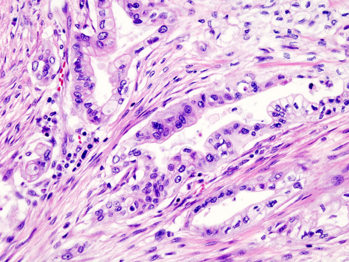 File:Pancreas adenocarcinoma - 3.jpg