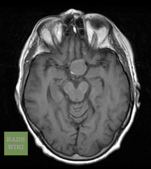 There is a well defined round lesion noted in the pituitary fossa, the lesion is homogeneous and isodense on T1.[4]