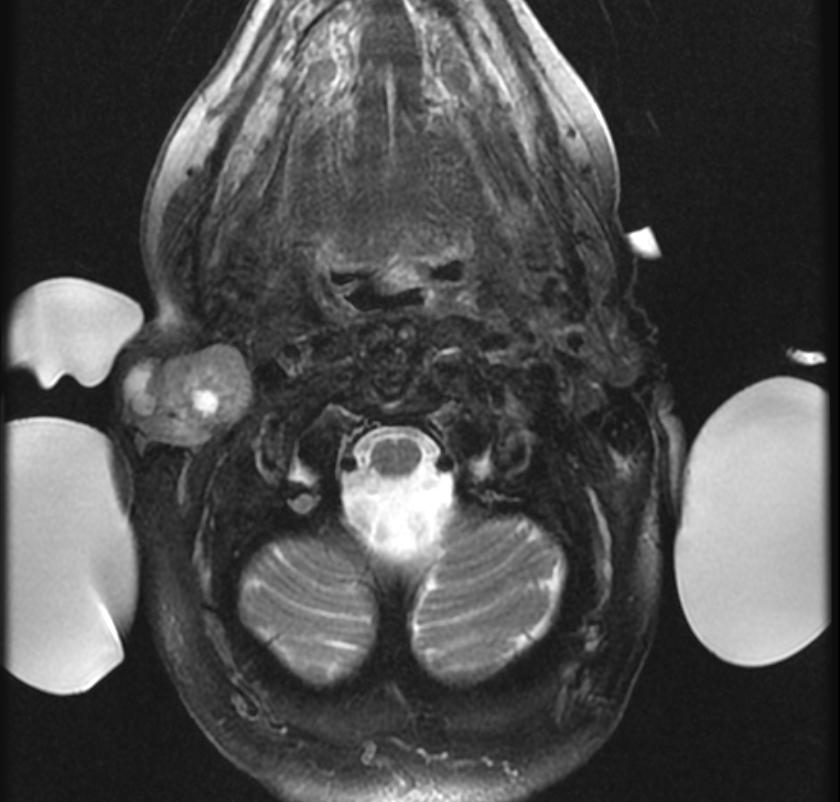 MRI: A right parotid pleomorphic adenoma