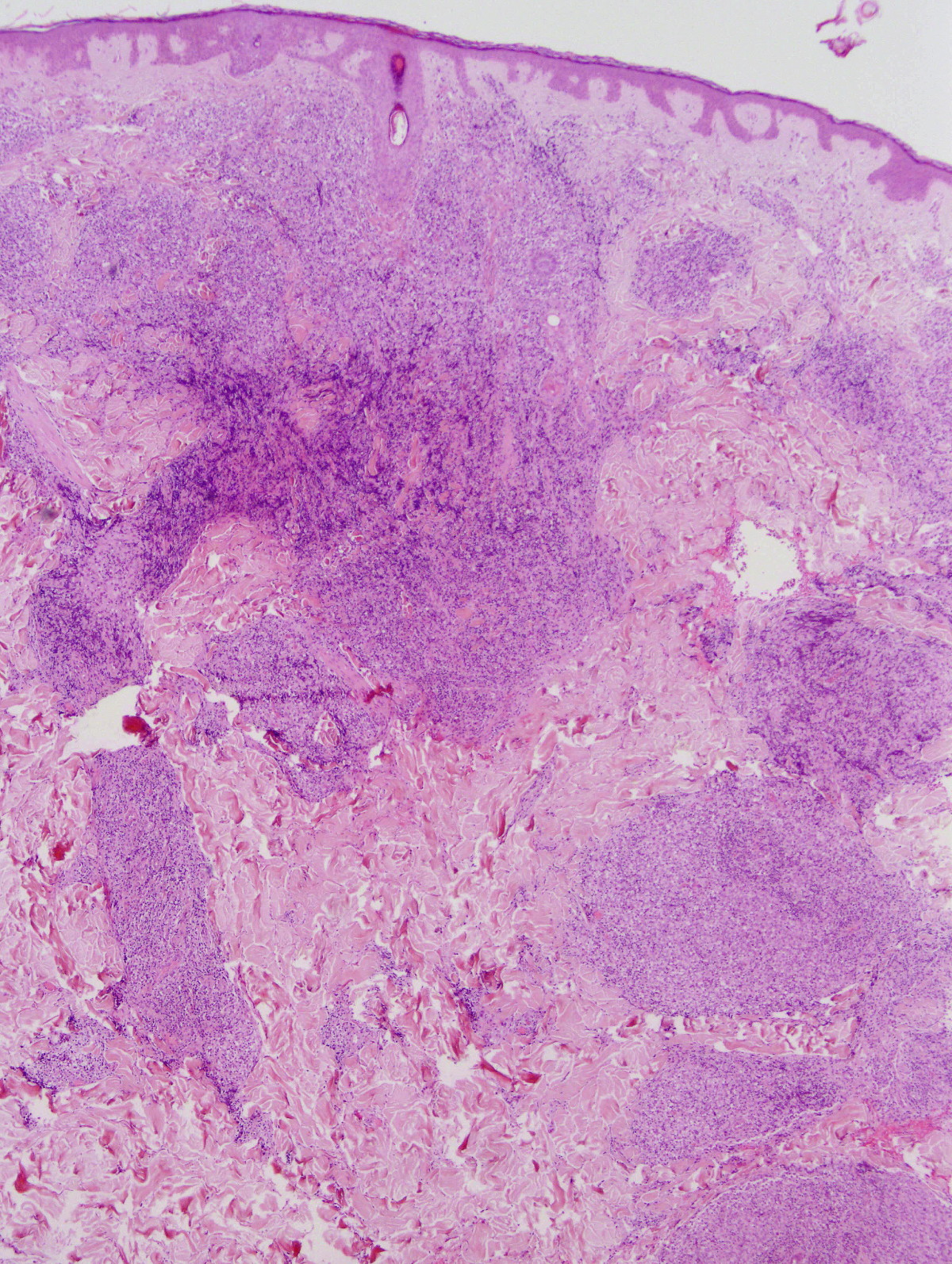File:Primary cutaneous follicle centre lymphoma image 06.jpg