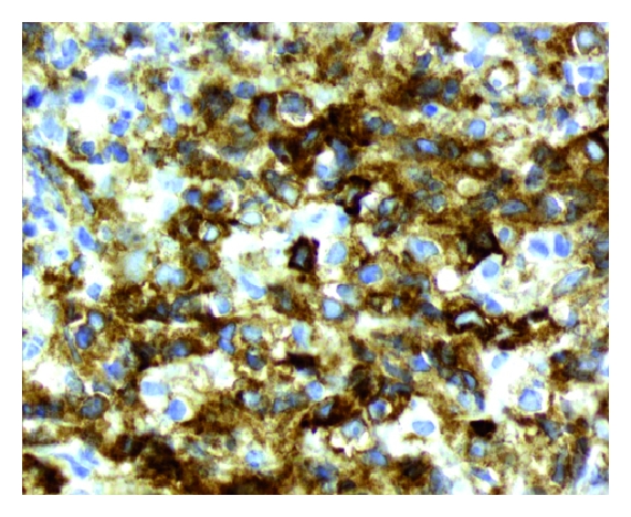 Primary mediastinal large B-cell lymphoma immunoreactivity for CD30[5]