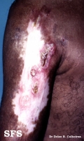 Lupus Erythematosus-Subacute Cutaneous Lupus Erythematosus. Adapted from Dermatology Atlas.[1]