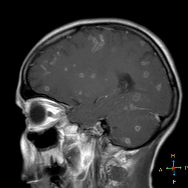 Sagital T1-weighted MRI head of a 39 year old middle eastern female with breast cancer, complaining of headache and confusion, demonstrates multiple small scattered intraparenchymal ring enhancing lesions proved to be metastatic deposits.[10]