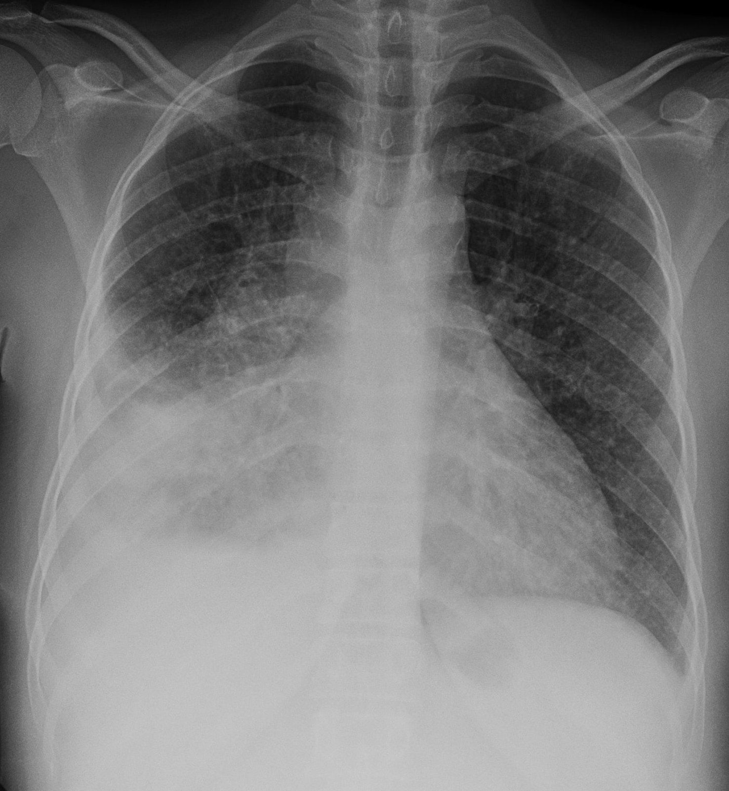 File:Miliary Tuberculosis.jpg