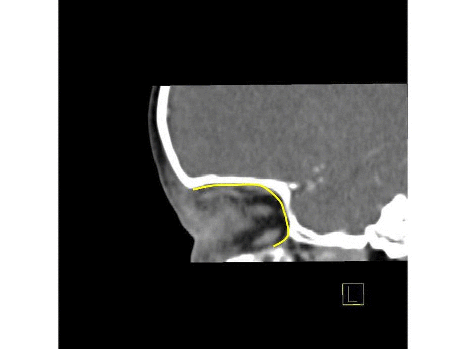 Preseptal and postseptal orbital cellulitis sagittal plane CT scan