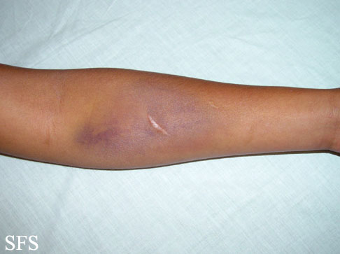 Painful bruising syndrome. Adapted from Dermatology Atlas.[5]