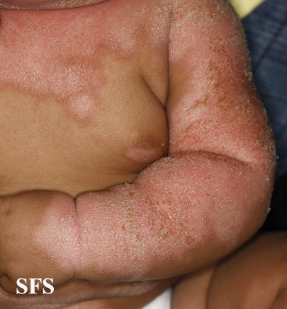 File:Seborrhoeic dermatitis 18.jpeg