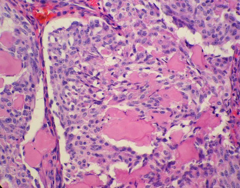 Medullary thyroid carcinoma spindle cell<ref> Medullary thyroid cancer librepathology