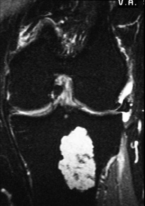 Low grade chondrosarcoma. Differential diagnosis is bone infarct (on plain film) and enchondroma