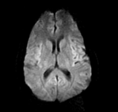 File:Normal-brain-MRI-002.jpg