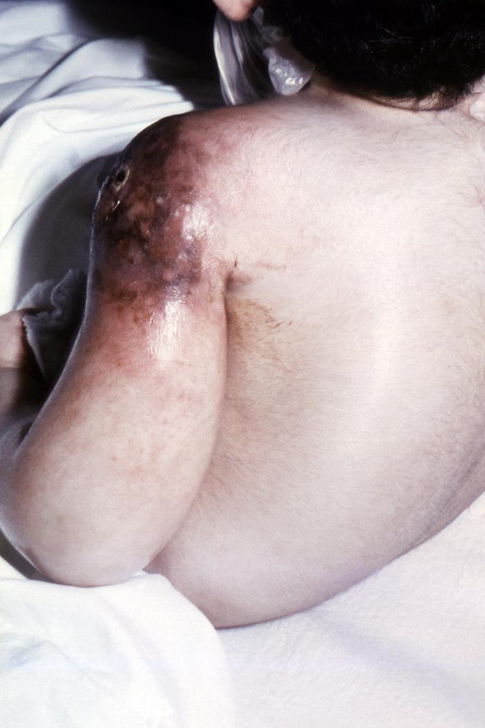 5 week-old male patient developed erythema multiforme after having received a smallpox vaccination. Note the diffuse rash over all body regions.Adapted from Public Health Image Library (PHIL), Centers for Disease Control and Prevention.[3]