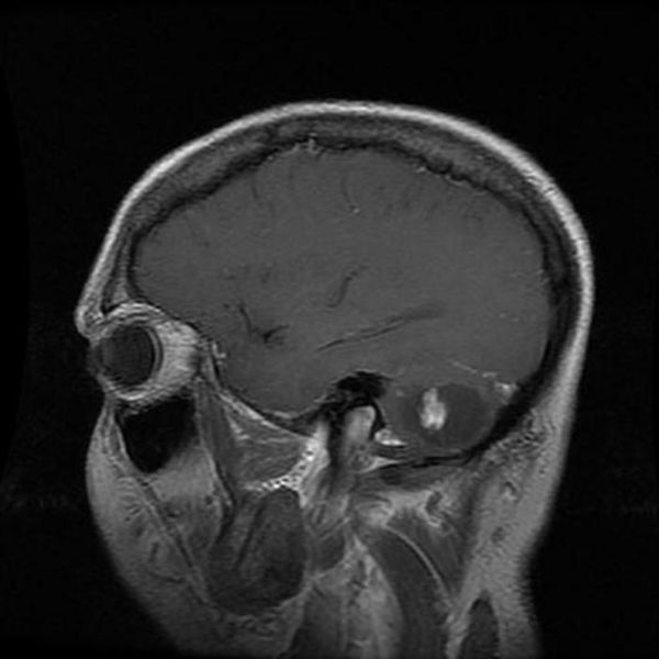 File:Hemangioblastoma-004.jpg
