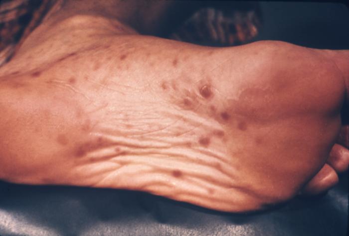 This patient presented with a papular rash on the sole of the foot due to secondary syphilis. The second stage of syphilis starts when one or more areas of the skin break into a rash that appears as rough, red or reddish brown spots both on the palms of hands and on the bottoms of feet. Even without treatment, rashes clear up by itself. Adapted from CDC