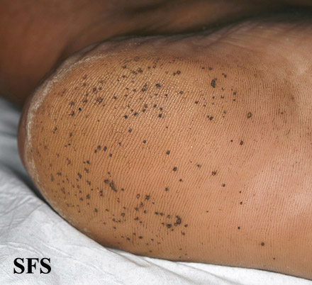 Pitted keratolysis. Adapted from Dermatology Atlas.[2]