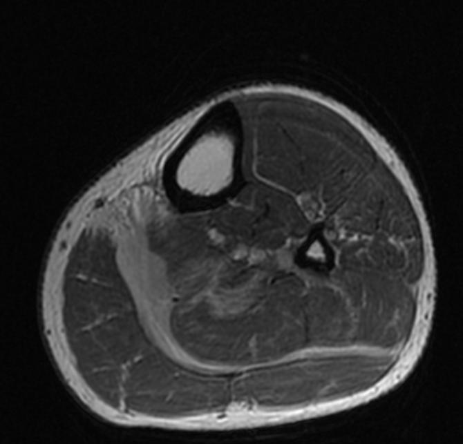 File:Plantaris rupture MRI 003.jpg