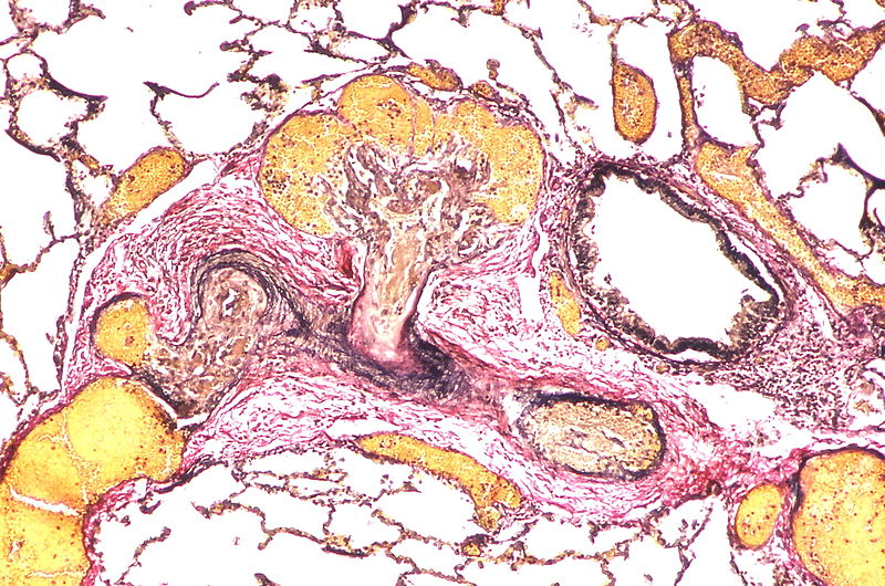 Two angiomatoid lesions are present. A large dilatation lesion is a present adjacent to the angiomatoid lesion that is located just above center.