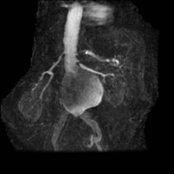 File:Renal artery stenosis 024.jpg