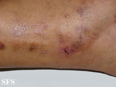 File:Vasculitis leukocytoclasia 07.jpeg