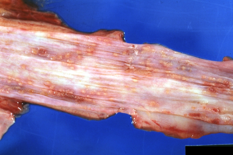 Esophagitis Candida: Gross natural color close-up, an excellent example