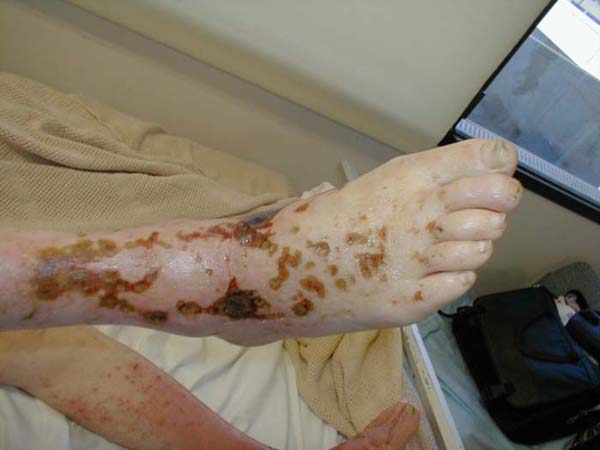 Chronic arterial insufficiency has resulted in pale, hairless, and somewhat shiny appearing lower extremity. Superficial ulcers are also apparent. (Image courtesy of Charlie Goldberg, M.D., UCSD School of Medicine and VA Medical Center, San Diego, California)