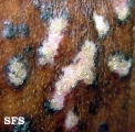 Lupus Erythematosus Chronicus Disseminatus Superficialis. Adapted from Dermatology Atlas.[9]