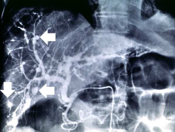 This angiogram of the liver also demonstrates numerous aneurysms throughout the hepatic circulation (arrows).