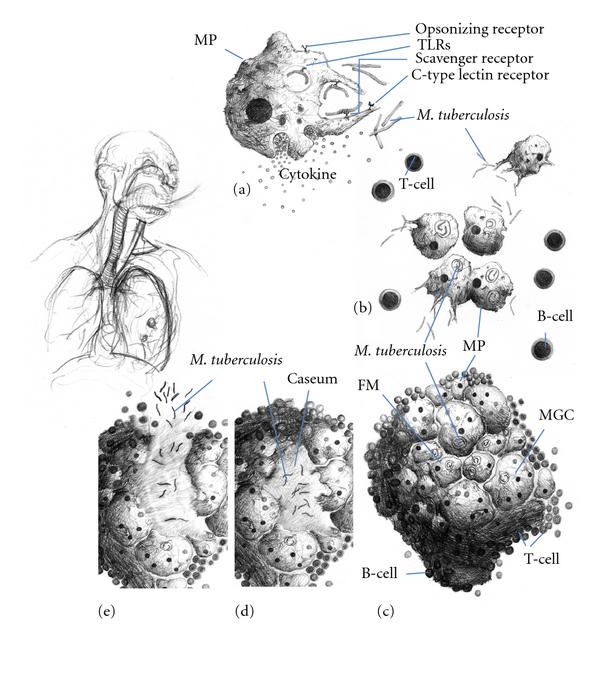 File:Granuloma Formation in Tuberculosis.jpg