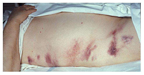 File:Hemorrhagic pancreatitis - Grey Turner's sign.jpg