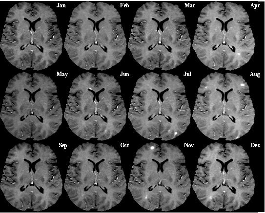 T1-weighted MRI scans (post-contrast) of same brain slice at monthly intervals. Bright spots indicate active lesions.