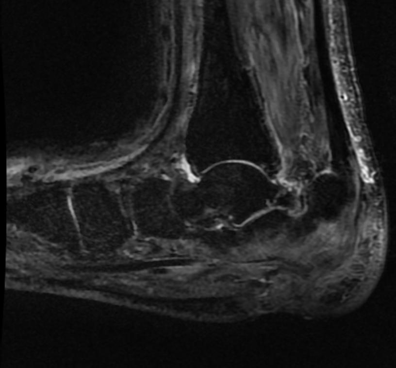 File:Osteomyelitis MRI 002.jpg