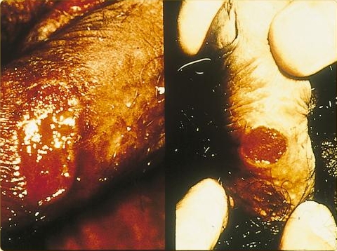 Genital ulcer in a male patient with Donovanosis.Adapted from Dermatology Atlas.[4]