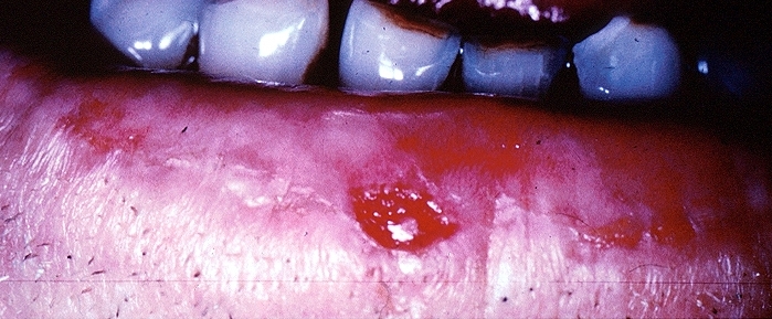 Squamous cell carcinoma in oral cavity